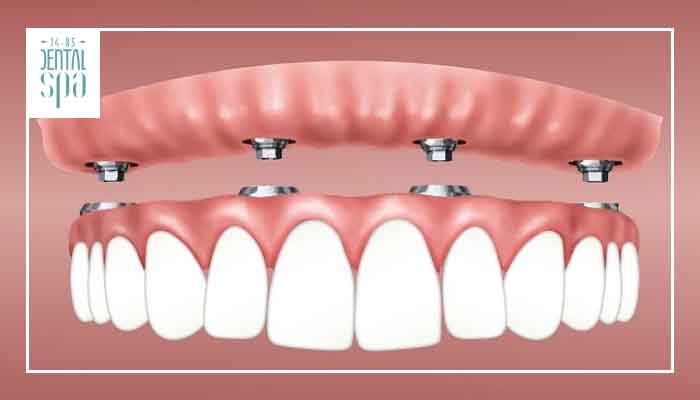 5 cuidados que debes tener con tus implantes dentales