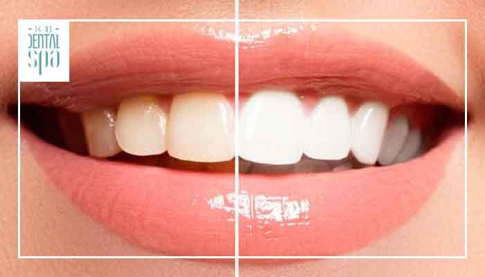 7 consejos blanqueamiento dental