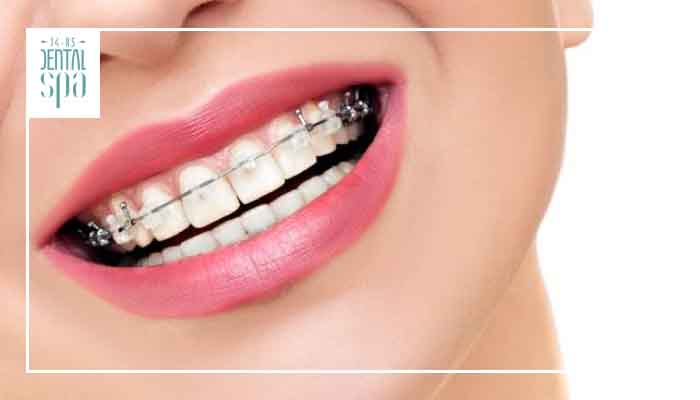 5 características para tener en cuenta de la ortodoncia en Bogotá