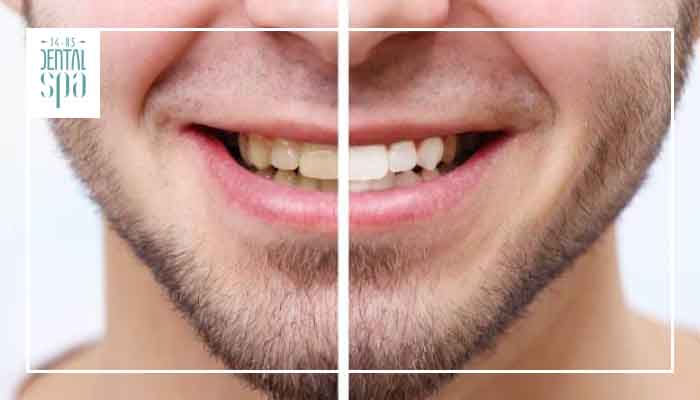 5 aspectos que debes conocer sobre el blanqueamiento dental