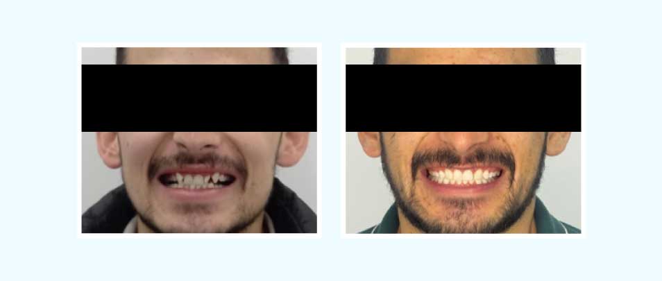 antes y despues tratamiento odontológico caso de exito